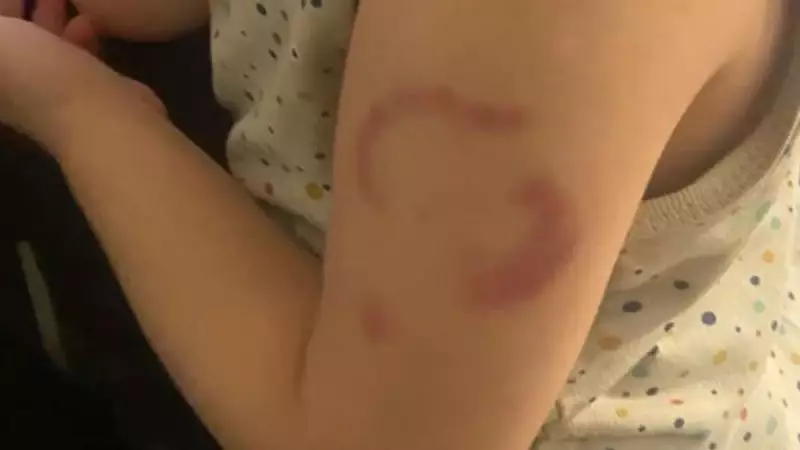 Edirne'de Kreş Skandalı: Öğretmen Tarafından Isırılan Çocuğun Ailesi İsyanda!