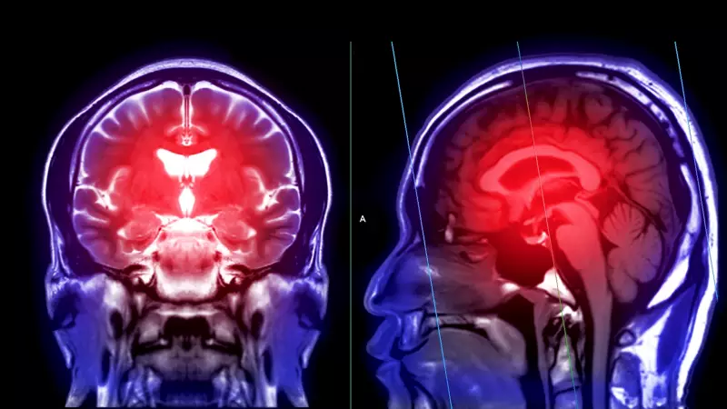 Gençlerde İnme Riski Artıyor: Uzmanlar Alarma Geçti!