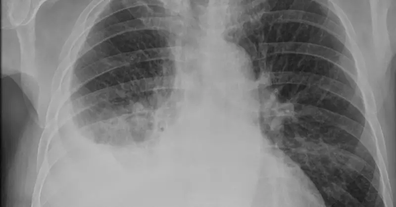 Akciğerde Su Toplanması Tedavisi: Süre ve Yöntemler