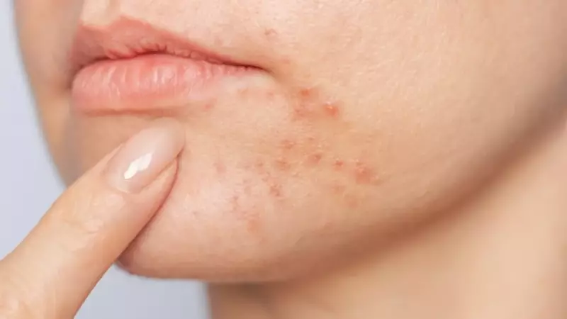 Bilim İnsanlarını Şoke Eden Keşif: Biberiye İle Cilt Lekelerine Elveda!