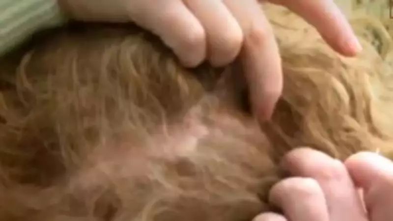 Estetik Cerrahında Skandal: Hastanın Kafasında Unutulan İğne