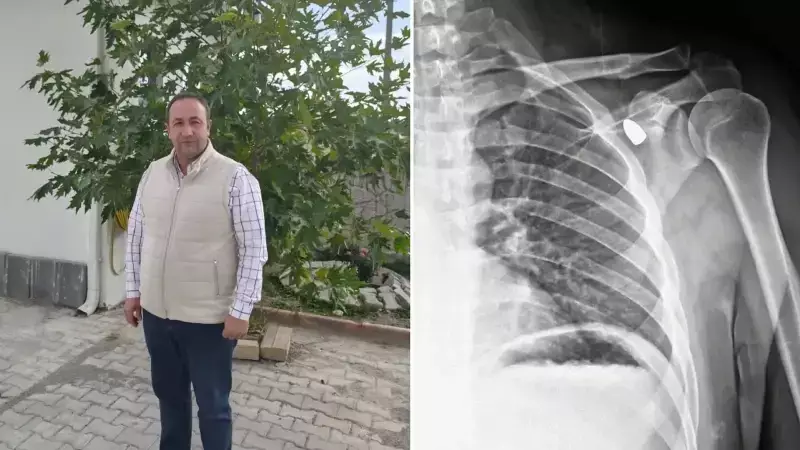 Okul Müdürünün Omzundaki Mermi 6 Yıl Sonra Koltuk Altına İlerledi