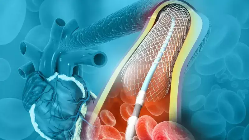 Stent Sonrası Hayati Uyarı: İlk 6 Ay En Riskli Dönem