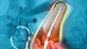 Stent Sonrası Hayati Uyarı: İlk 6 Ay En Riskli Dönem