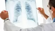 Uzmanlar Uyarıyor: Tekrarlayan Zatürre Akciğer Kanseri Habercisi Olabilir