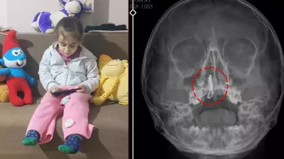 Rize'de 5 Yaşındaki Kızın Burnundan 2 Yıllık Tırnak Makası Zinciri Çıktı!