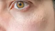 Ciltteki Beyaz Noktalar: Milia Nedir ve Kurtulmanın En Etkili Yolu