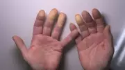 Soğukta Parmak Morarması Raynaud Hastalığına İşaret Edebilir