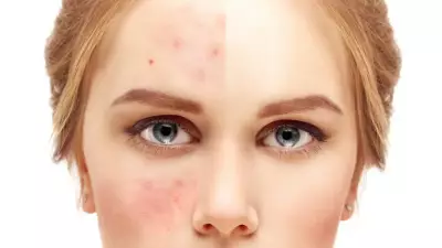 Gül Hastalığı (Rozasea) Belirtileri ve Tedavisi: Uzman Uyarısı