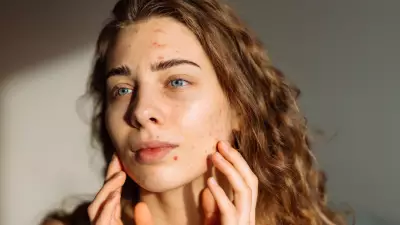 Sivilceyi kuruturken artıran 14 hata: Ani akne artışında kaçının