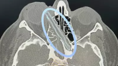 Göz ağrısı şikayetiyle gitti, kafatasından çıkan cisim doktorları şaşkına çevirdi