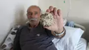 Böbrek Ağrısından Kurtuldu: Mesanesinden Elma Büyüklüğünde Taş Çıktı