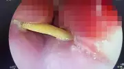 Yutkunamadı, nefes alamadı! Yemek borusunda 5 santimetrelik kemik bulundu