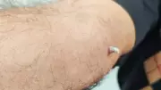 Kolundaki yara için hastaneye gitti, cilt kanseri olduğunu öğrendi