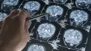 Alzheimer Tedavisinde Yeni Umut: 40 Hertz Ses Beyni Temizliyor