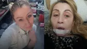 Antalya'da estetik faciası: İşlem sonrası dudağı çürüdü, 7 yıldır hukuk mücadelesi sürüyor