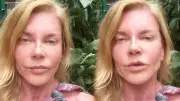 Biricik Suden'den Estetik İddialarına Sert Yanıt: Dermapen Cilt Bakımıdır