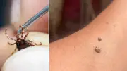 Tokat'ta 10 Kişi KKKA Hastalığı Teşhisiyle Tedavi Görüyor