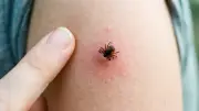 Tokat'ta 4 Kişi KKKA Hastalığı Teşhisiyle Tedavi Görüyor