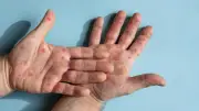 Yazın çocuklarda hızla yayılan el-ayak-ağız hastalığına dikkat!